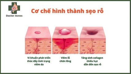 Sẹo rỗ là gì? Nguyên nhân và cơ chế hình thành sẹo rỗ