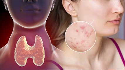 Thyroid Side Effects On Skin Reason & Treatment | Thyroid Effects On Skin Care Tips | Boldsky