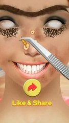 Asmr Worm Maggots Removal Animation Infected Face Treatment  asmr  animation  satisfy