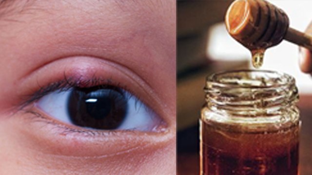 Bilni kaise Thik Hota hai : Stye Eye Causes And Symptoms |Boldsky