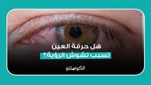 هل حرقة العين تسبب تشوش الرؤية؟