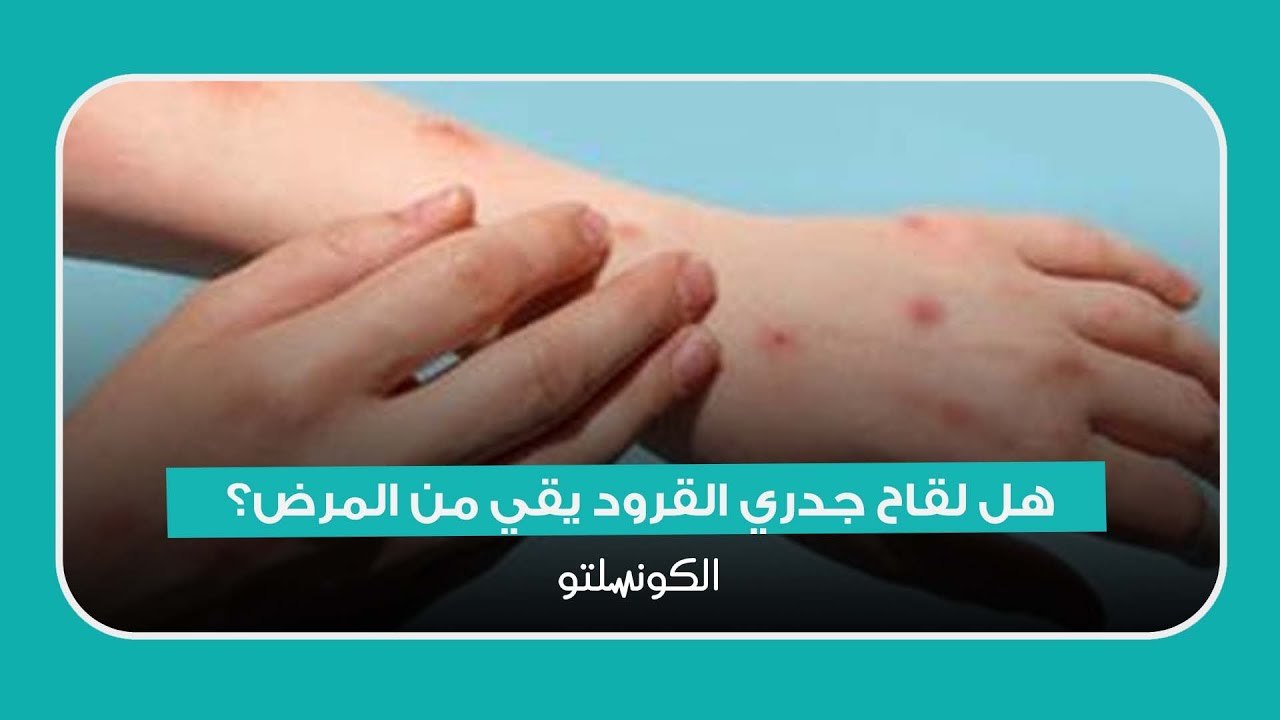 هل لقاح جدري القرود يقي من المرض؟