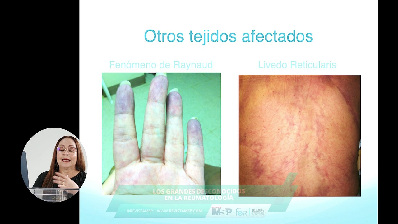 Grandes desconocidos de la reumatología: Lupus eritematoso sistémico