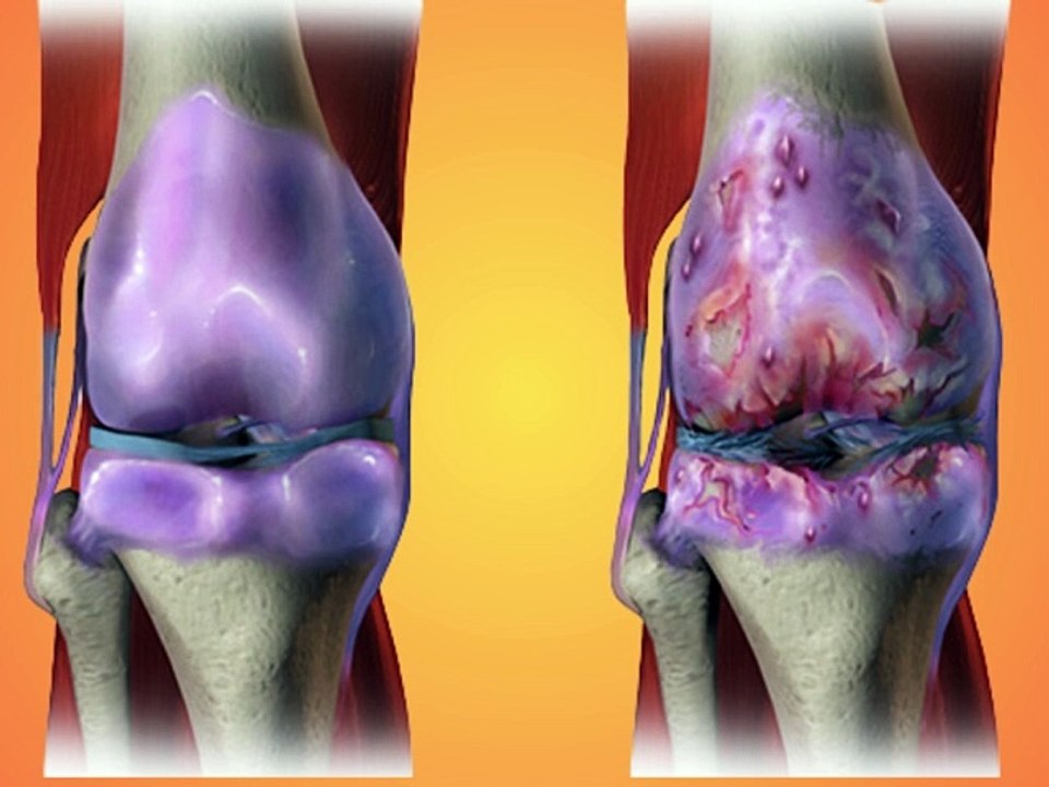 osteoarthritis & rheumatoid arthritis differences | ऑस्टियोआर्थराइटिस, रुमेटीइड आर्थराइटिस में अंतर
