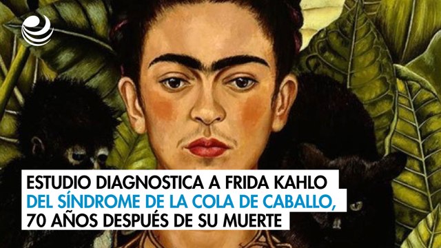 Estudio diagnostica a Frida Kahlo del síndrome de la cola de caballo, 70 años después de su muerte