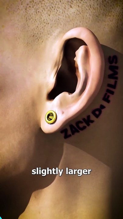 How Ear Gauges Can Tear Your Ears
