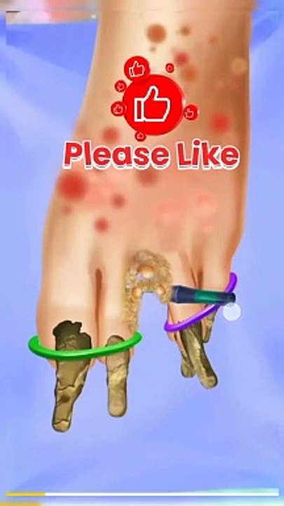 ASMR Remove Stonefish sting from foot P2 asmr  viralvideo  trending youtubeshorts