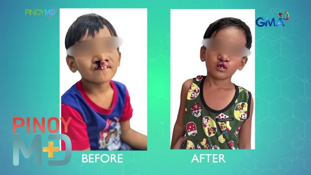 Libreng operasyon sa mga batang may cleft lip at cleft palate, panoorin! | Pinoy MD