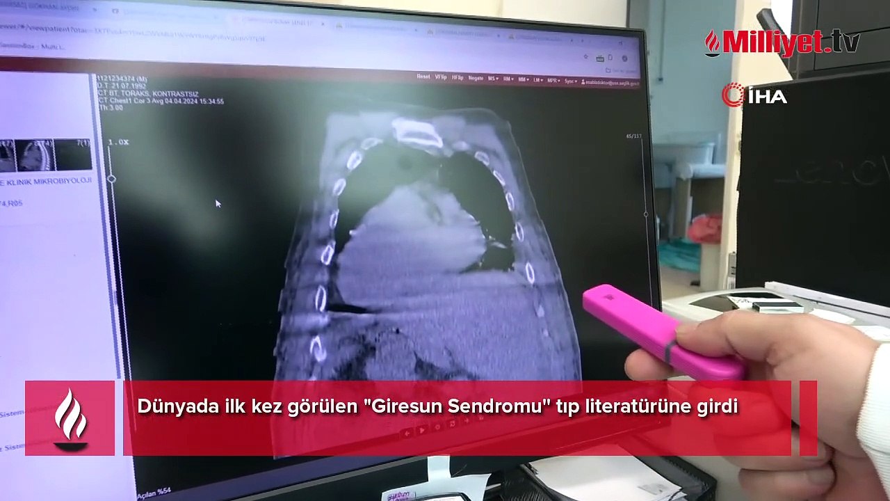 Dünyada bir ilk: Giresun Sendromu! Tüm organlar yer değiştiriyor