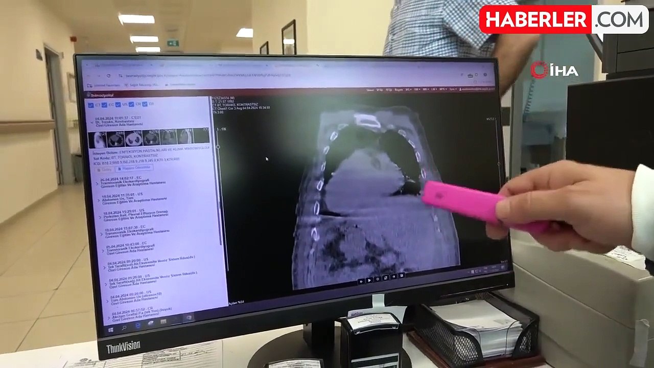 Dünyada İlk Kez Tanımlanan 'Giresun Sendromu' Tıp Literatürüne Girdi