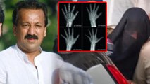 Baba Siddiqui Case: Shooter Dharmraj Kashyap Bone Ossification Test Reason, Right Age Clarify..