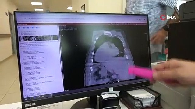 Dünyada ilk kez görülen ''Giresun Sendromu'' literatüre girdi