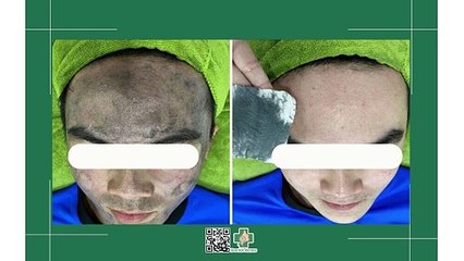 Sự thật về hút chì da mặt để thải độc cho da mặt