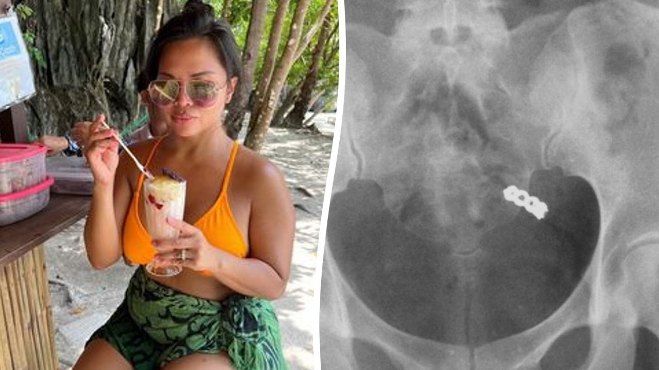 X-ray shows woman's wedding ring after she accidentally swallowed it