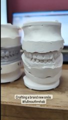 Smile Makeover in Progress: Restoring Confidence with a Healthy New Smile!