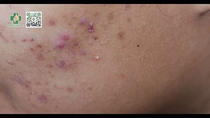 BHA đẩy mụn trong bao lâu? Cách xử lý khi làn da bị đẩy mụn