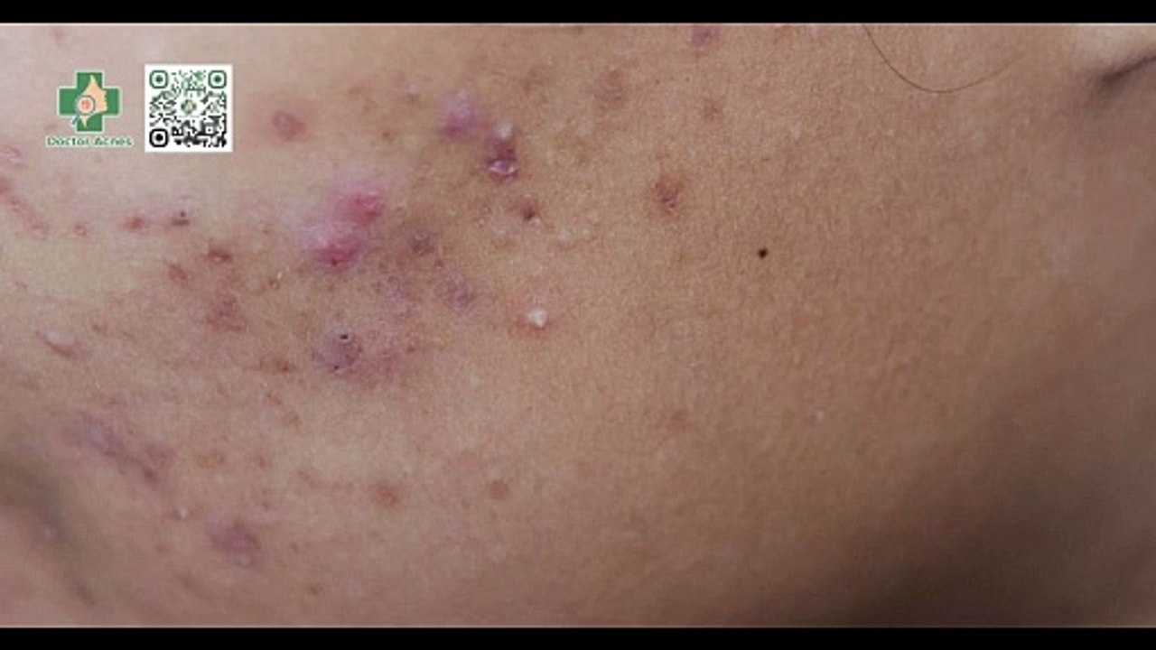 AHA có đẩy mụn không? Cách chăm sóc da trong thời gian đẩy mụn