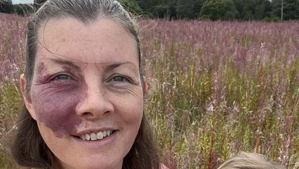 Mom Embraces Her Birthmark After 34 Years of Hiding It for Her Kids 💖