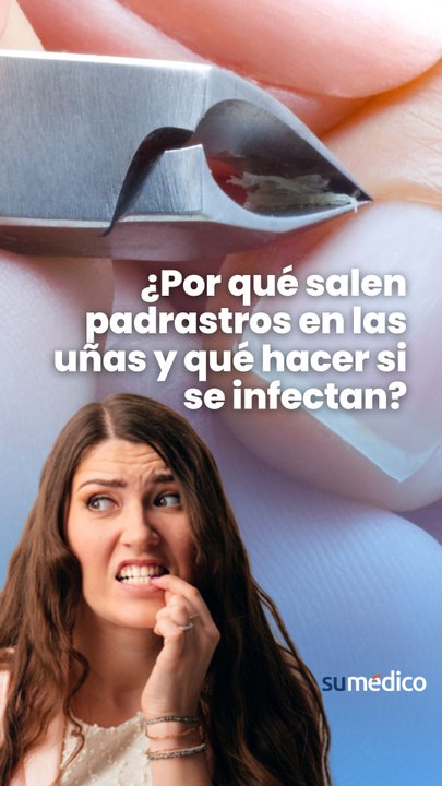 ¿Por qué salen padrastros en las uñas y qué hacer si se infectan?