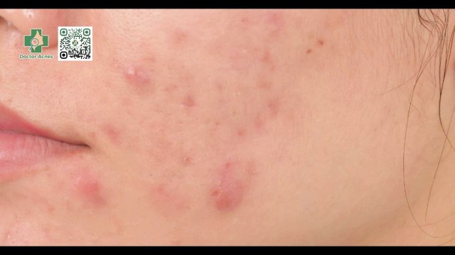 Mụn chai là gì? Cách điều trị mụn chai hiệu quả hiện nay