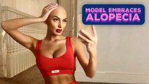 Model embraces her alopecia