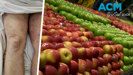 Cost of living crisis causing a rise in scurvy as fresh food becomes more expensive