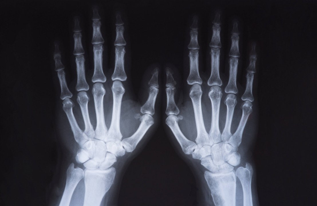 Artificial intelligence (AI) can help doctors spot broken bones on X-rays