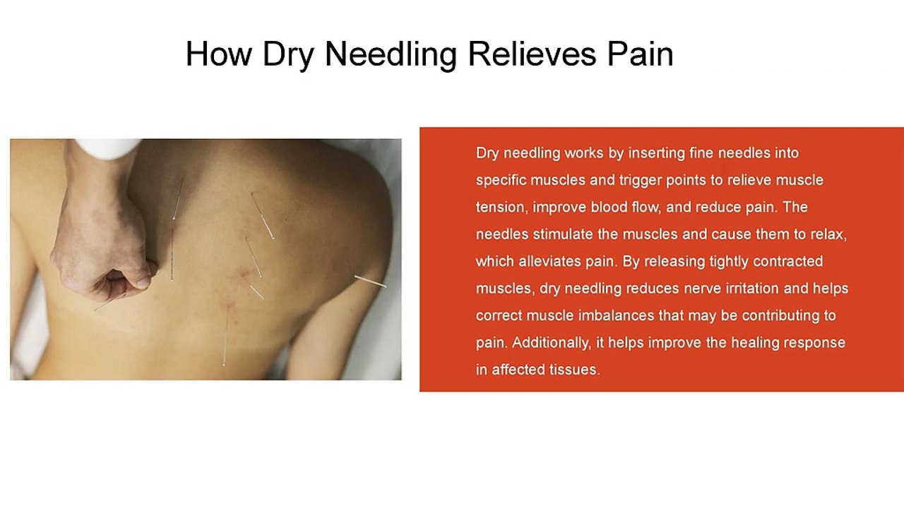 Effective Dry Needling Physiotherapy for Pain Relief | Go Run Go Physio