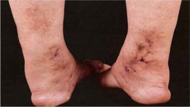 Liver Damage Symptoms In Legs: पैरों में दिखते है लिवर डैमेज के लक्षण, Cracked Heels To Itching