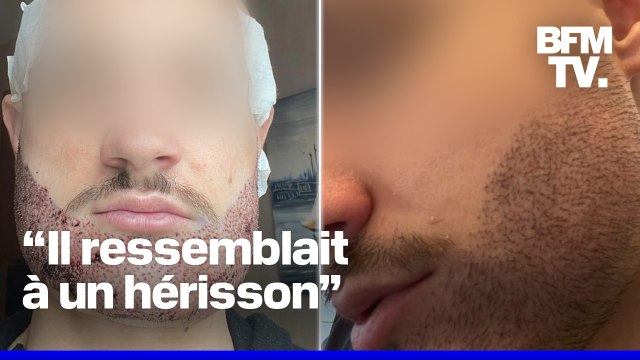 “Rien ne laissait supposer qu’il allait passer à l’acte”: le témoignage du père de Mathieu, 24 ans, qui a mis fin à ses jours en juin dernier à cause d’une greffe de barbe ratée en Turquie