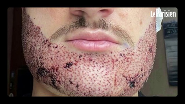 « Son visage n'était plus du tout le même » : Mathieu se suicide après une greffe de barbe ratée en Turquie
