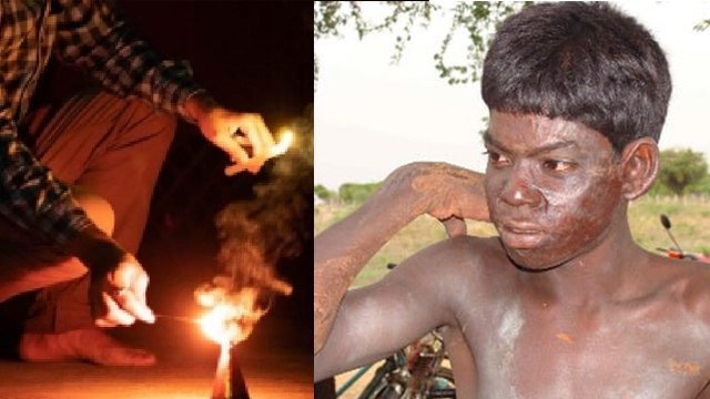 Cracker Burn Treatment: Patakhe Se Jalne Par Kya Kare, Pataka Se Jalne Par Kya Lagaye | Boldsky