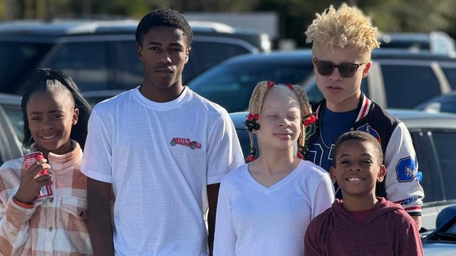 Two of my children have albinism - I thought doctors had given me the wrong baby