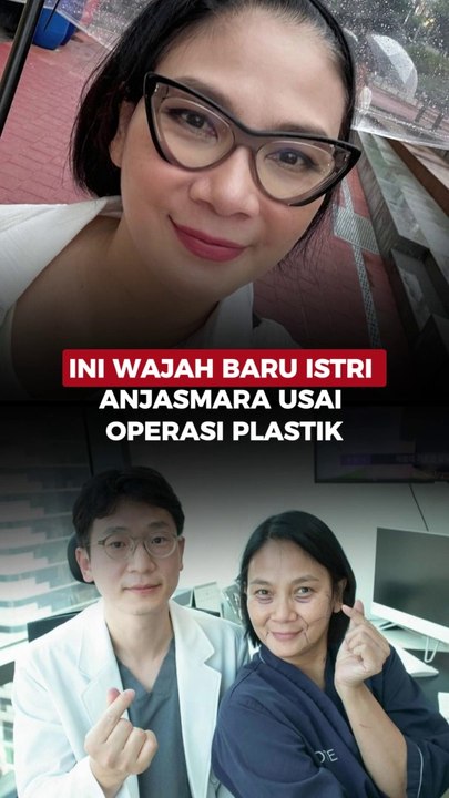 Ini Wajah Baru Istri Anjasmara Usai Operasi Plastik