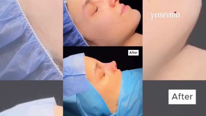 Kız kardeşler burunları aynı yere yaptırdılar! Ortaya çıkan sonuç...