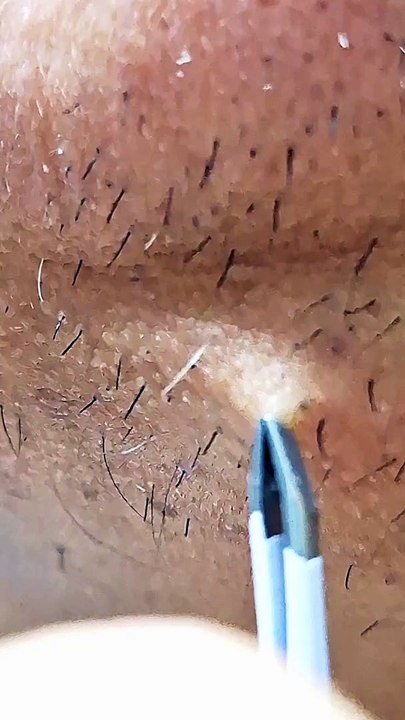 Plucking Facial Hair- Women's Beard Removal Tweezers - PCOS Warrior - Got Rid of my PCOS Facial Hair