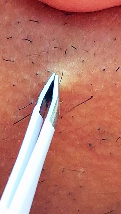 Plucking Facial Hair - Women's Beard Removal Tweezers - PCOS Warrior