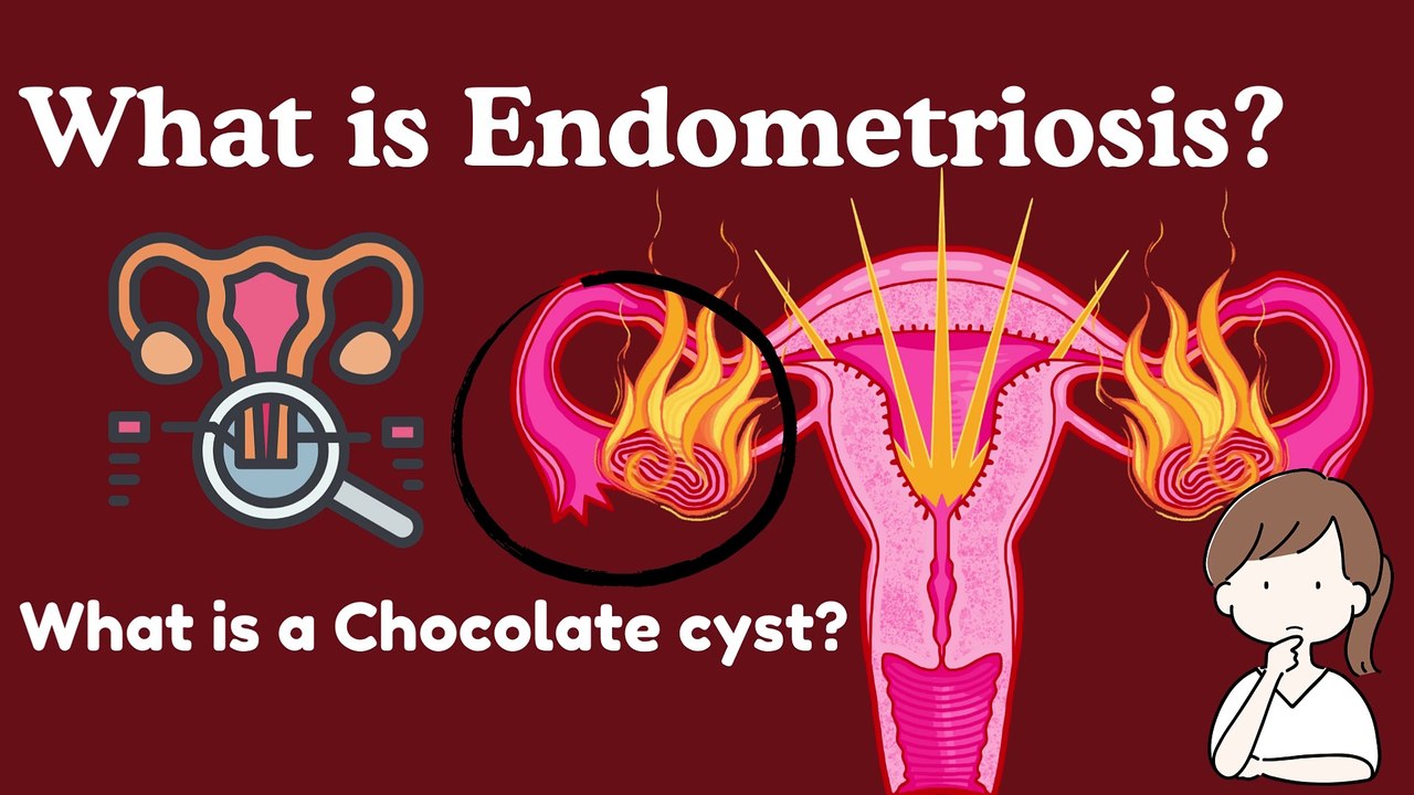 What is a Chocolate cyst and Endometriosis?
