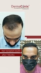 Remarkable Transformation with B.E.S.T. FUE by Dr. Amrendra Kumar at DermaClinix