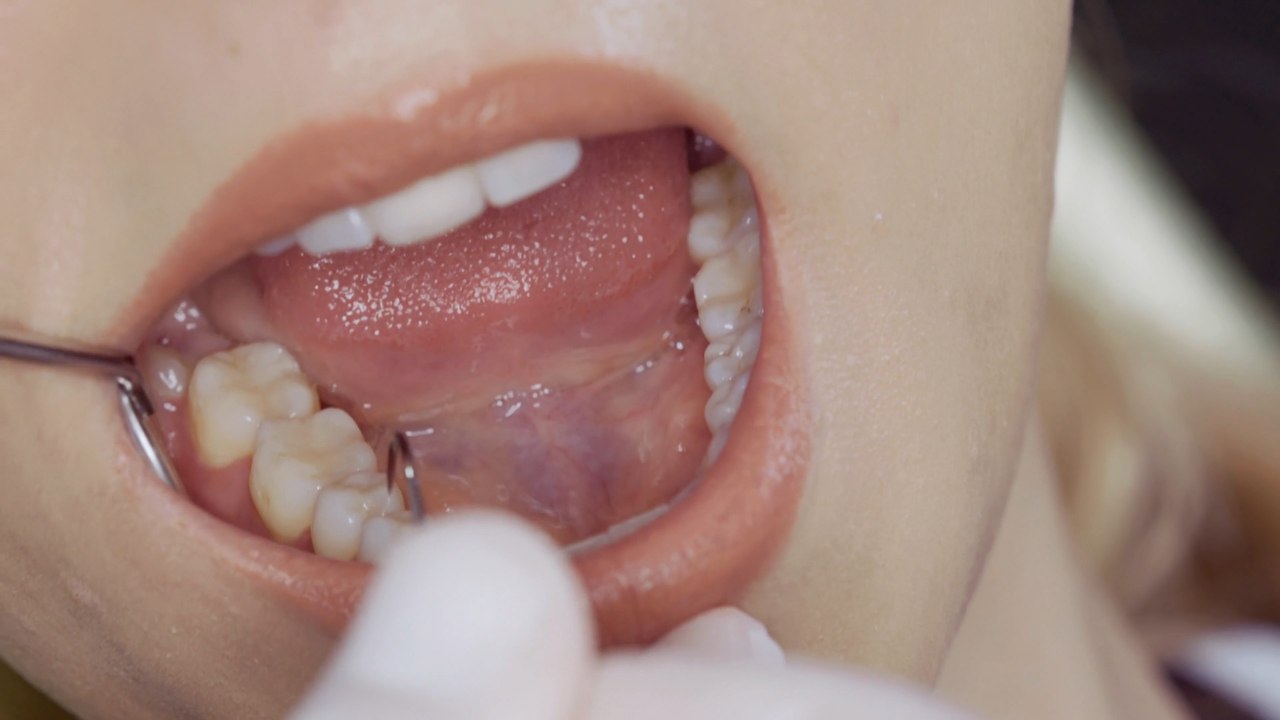 6.2 million patients waiting for an NHS dentist appointment: How to take care of your teeth if you can’t see a dentist