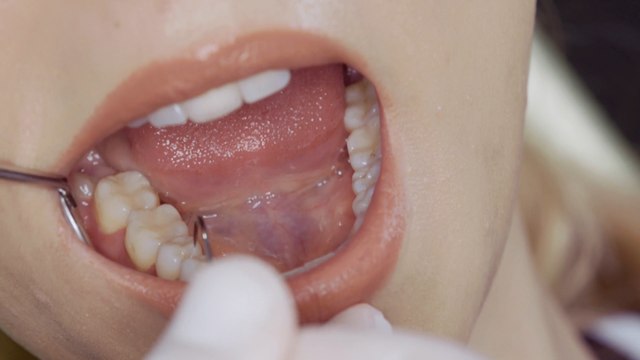 6.2 million patients waiting for an NHS dentist appointment: How to take care of your teeth if you can’t see a dentist