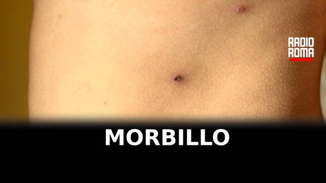 Aumentano i casi di morbillo nel Lazio