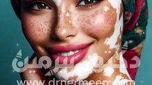 علاج البهاق من المنزل #اكسبلور #علاج #ترند #فوائد #فوائد_الاعشاب #صحه #بهاق #علاج