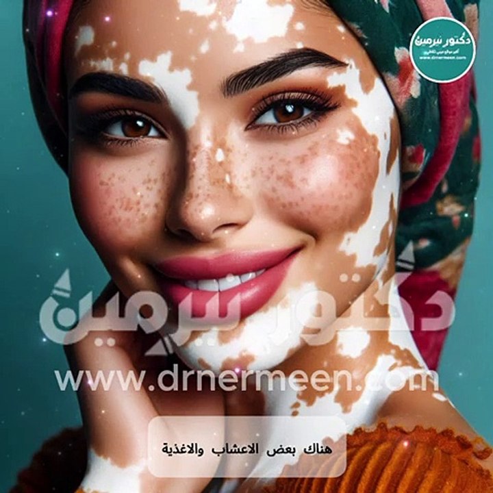 علاج البهاق من المنزل #اكسبلور #علاج #ترند #فوائد #فوائد_الاعشاب #صحه #بهاق #علاج