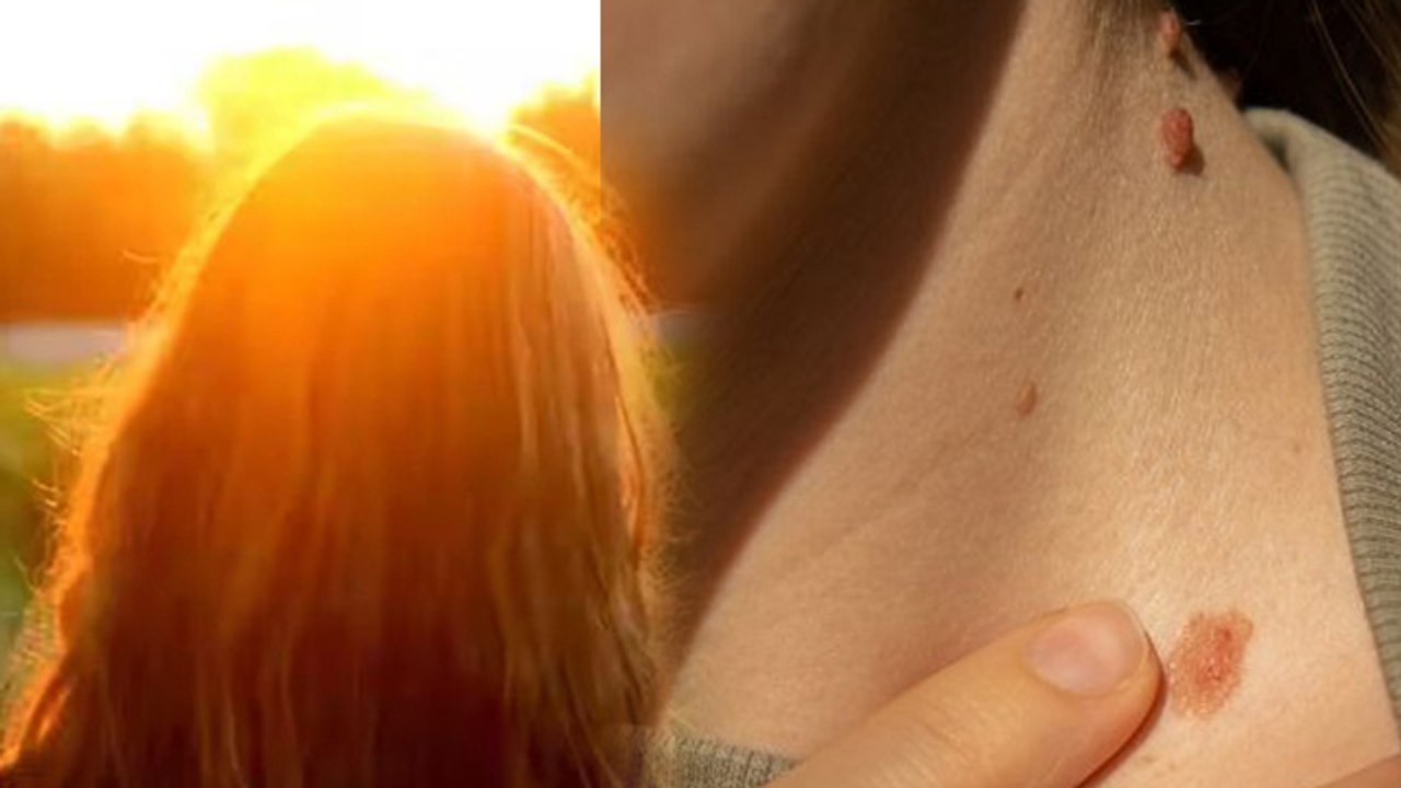 Sun Rays से Skin Cancer का Risk कैसे | Dhoop Se Skin Cancer Kyu Hota Hai