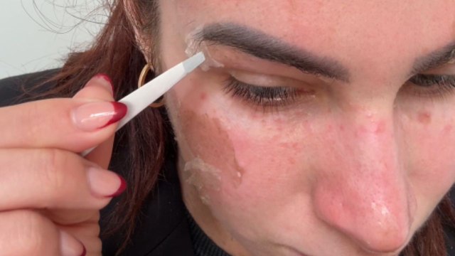 Fascinating video highlights enjoyable skin-peeling process after Elaine Brennan chemical peel treatment