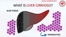 What is liver cirrhosis?