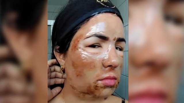 Entre el antes y el después del peeling de fenol