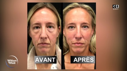 Votre beauté : Paupières qui tombent et poches sous les yeux, quelles solutions ?