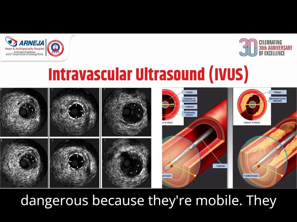 clot in transit #pocus #cardiology #emergencymedicine|Clot in Transit: Diagnosing and Treating a Silent Threat"